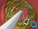 Stent Animation